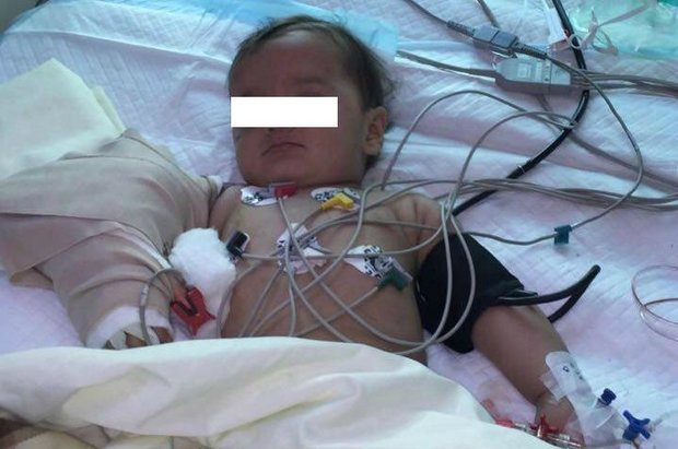 عمل پیوند دست نوزاد ۱۳ ماهه در شیراز با موفقیت انجام شد