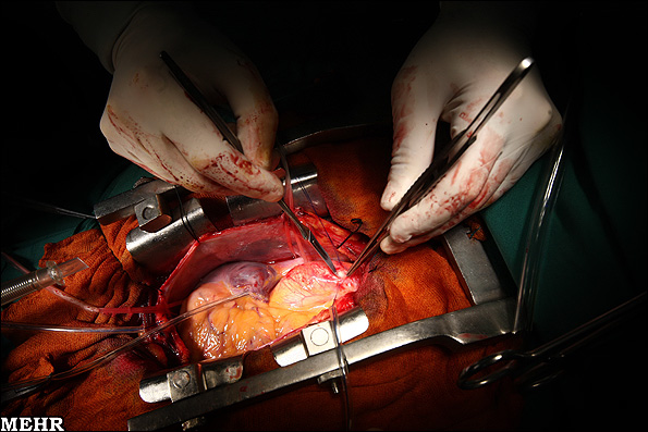 شیوه جدید جراحی قلب در شیراز بدون باز کردن قفسه سینه + ویدیو