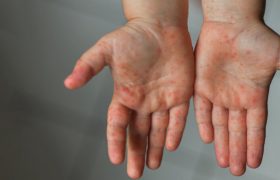 تب سرخک در فارس