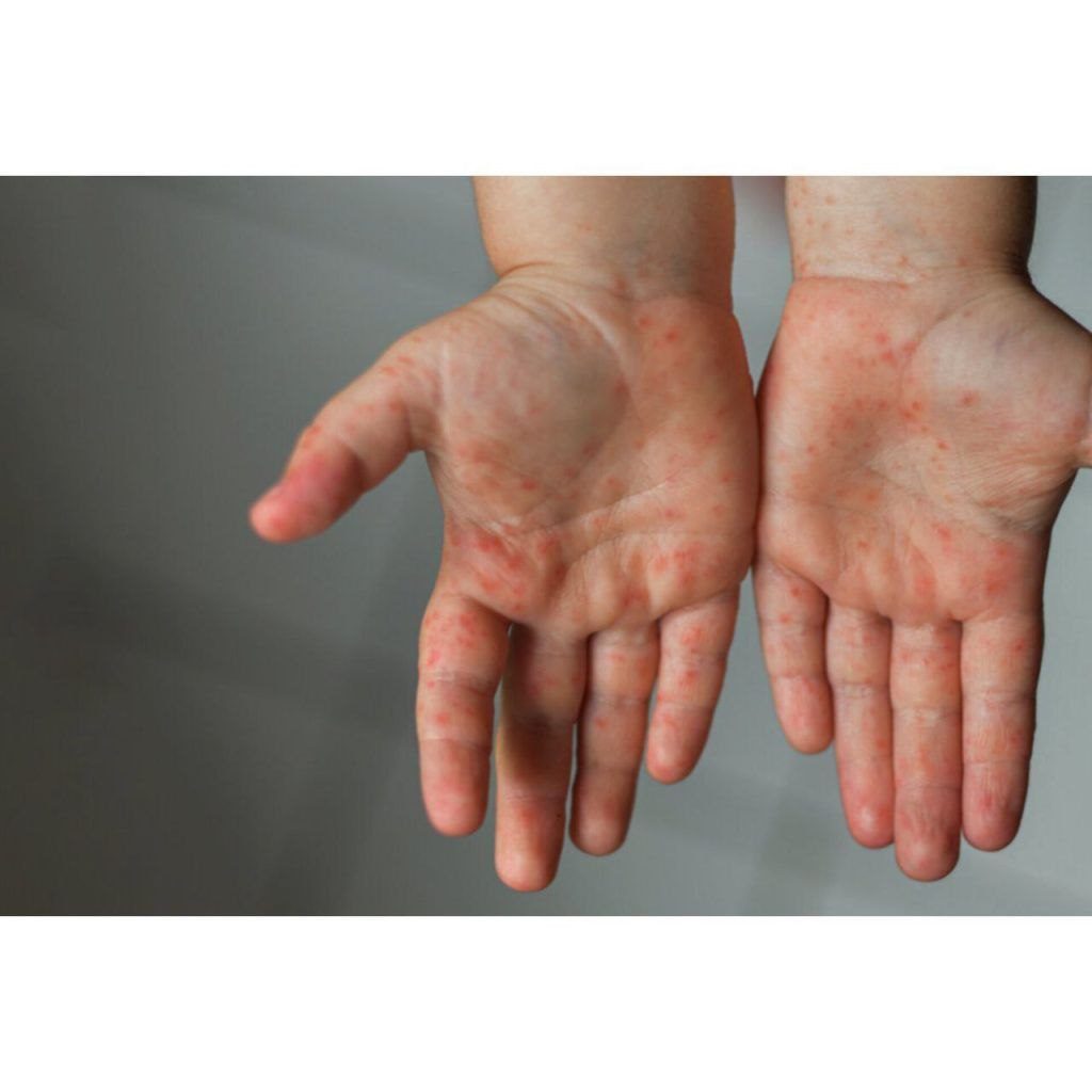 ۲۰ مورد قطعی ابتلا به سرخک در فارس شناسایی شد