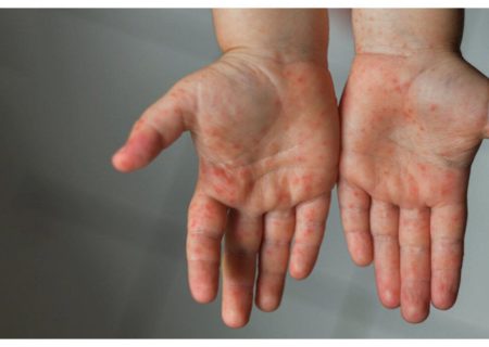 ۲۰ مورد قطعی ابتلا به سرخک در فارس شناسایی شد